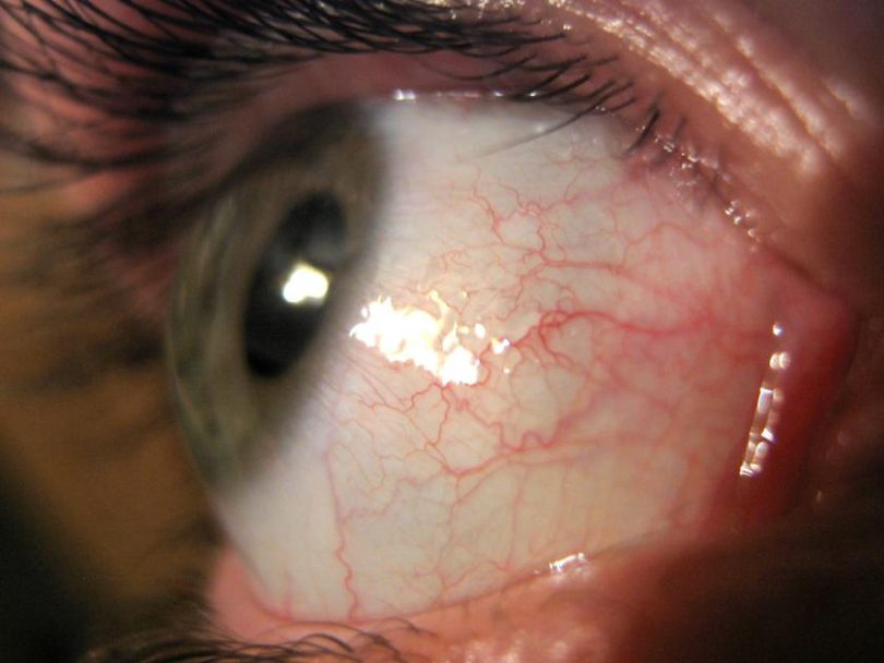 What Causes Eye Twisting Nerve Damage